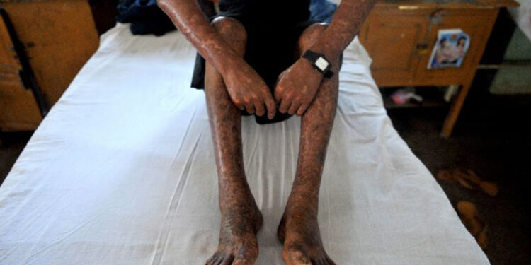 Of resurgent leprosy cases — Opinion — The Guardian Nigeria News – Nigeria and World News Of resurgent leprosy cases — Opinion — The Guardian Nigeria News – Nigeria and World News