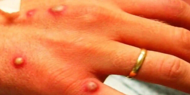 Brazil confirms its first monkeypox case | The Guardian Nigeria News