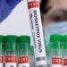Karnataka Bengaluru News Live Updates: Ethiopian man with suspected Monkeypox symptoms has chickenpox, says state Health Minister