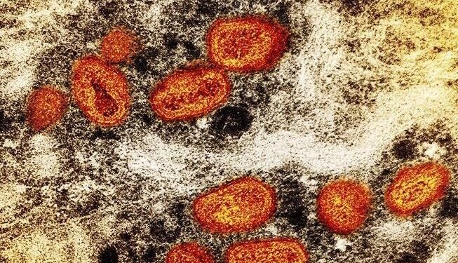 Monkeypox: 890 cases reported in Canada, majority in Ontario Monkeypox: 890 cases reported in Canada, majority in Ontario