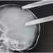 Kenyatta Hospital: Kenyans Moved by Death of Boy Whose Skull Was Logged with Fork Jembe Kenyatta Hospital: Kenyans Moved by Death of Boy Whose Skull Was Logged with Fork Jembe