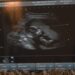 Mobile 4D ultrasound business in Rochester brings elective experience right to your home